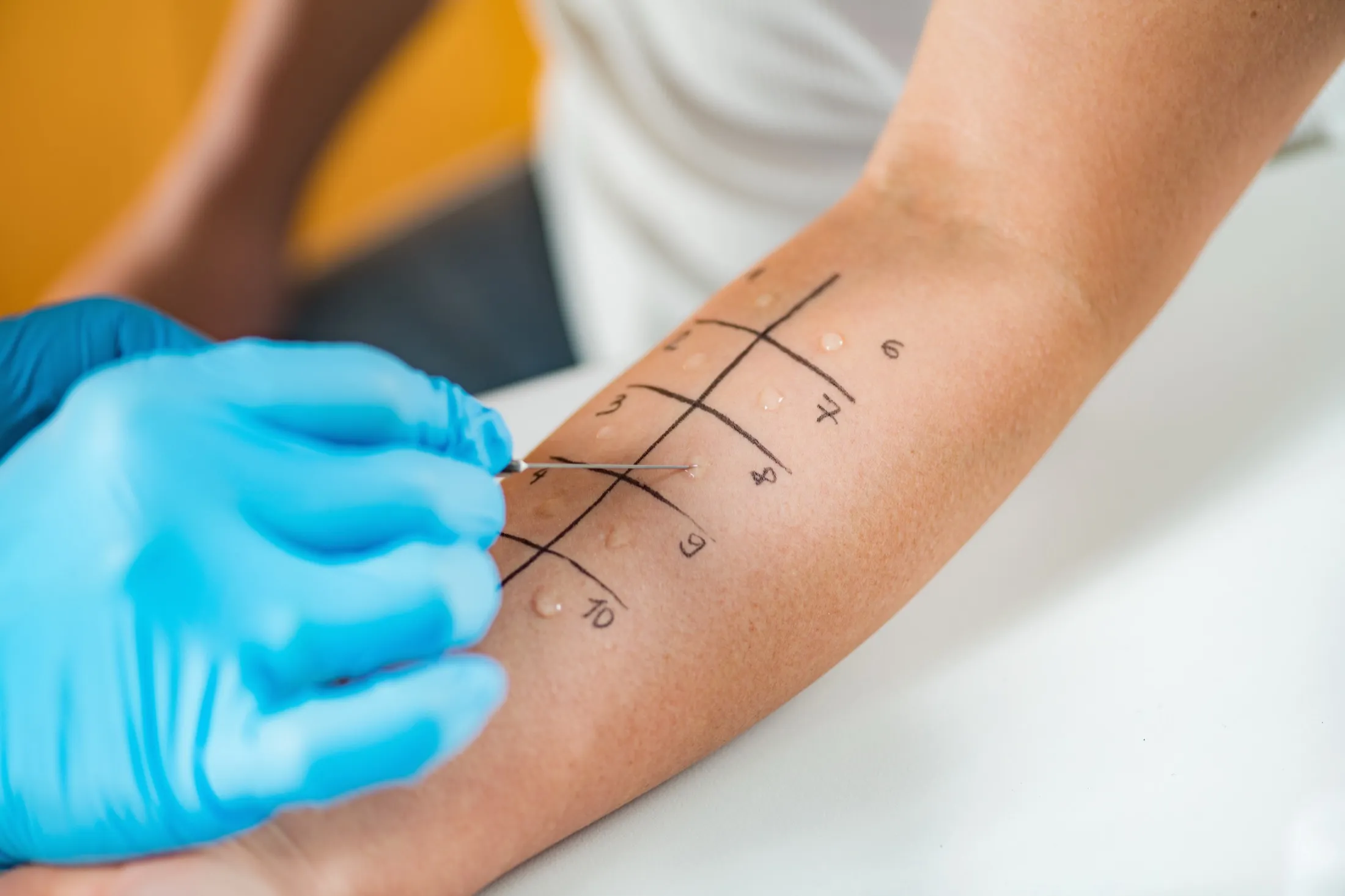 What to Expect During Allergy Testing